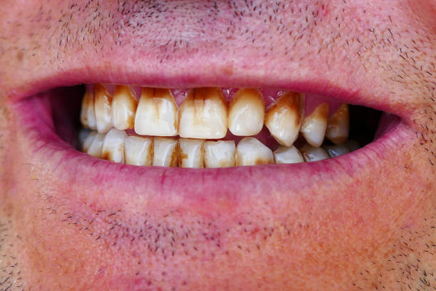 homem com dentes sujos