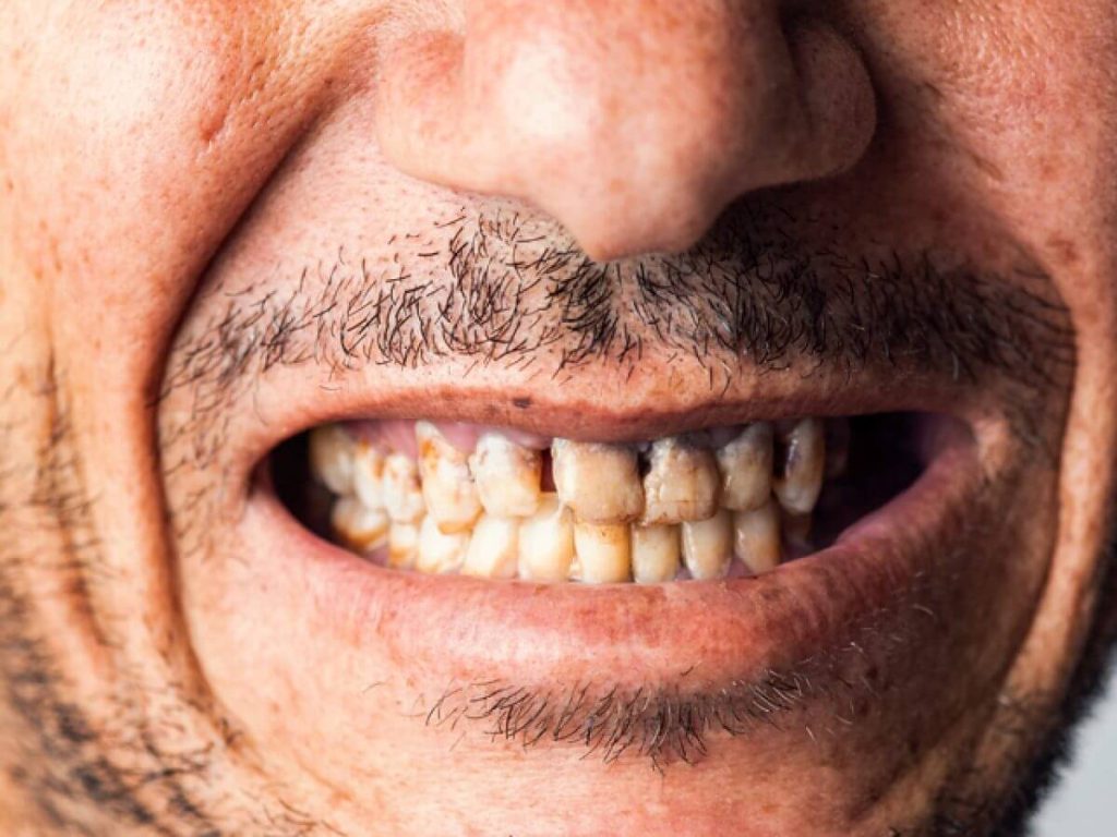 homem sorrindo com dentes sujos e feios